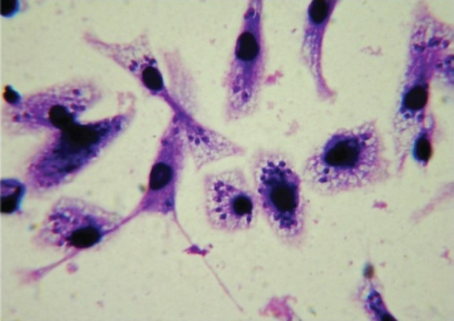 Stained (with giemsa stain) infected macrophages bearing amastigotes (100 X under oil immersion lens).
