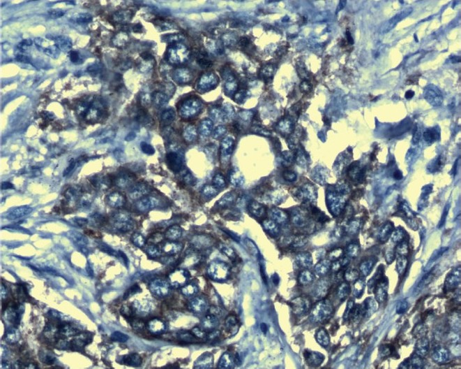 Her-2/neu positive slide stained with Haematoxylin (X 1000).