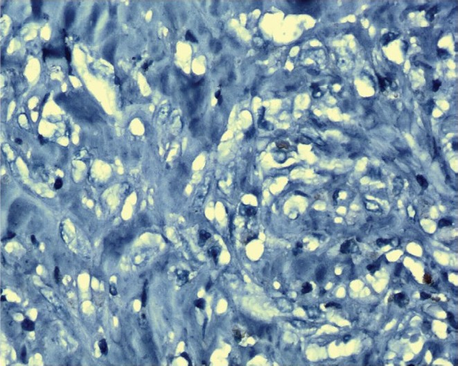 Her-2/neu negative slide stained with Haematoxylin (X 1000).