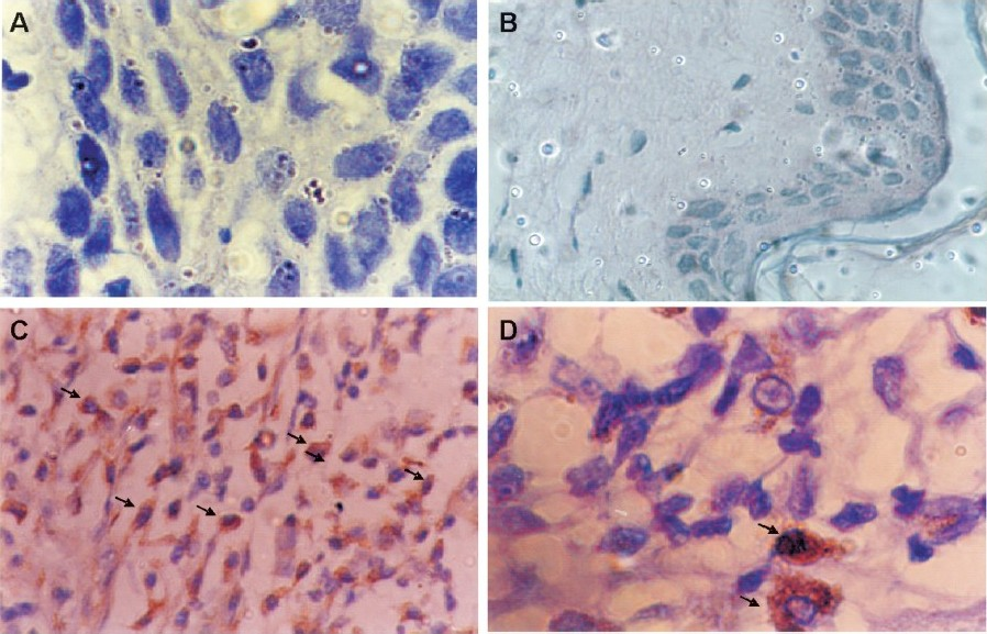 Immunohistochemical staining of cyclin D1 in tobacco-related intraoral squamous cell carcinoma using mouse monoclonal antibody; (A) negative control and (B) normal buccal mucosa are negative for cyclin D1; (C) moderately differentiated tumour cells show strong cytoplasmic and nuclear (arrows) immunoreactivity (magnification (40X); (D) shows intense nuclear and cytoplasmic immunoreactivity in tumour cells (arrow) under higher (100X) magnification.