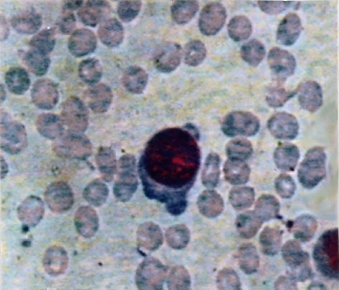 Giant pronormoblasts in Giemsa stained bone marrow smear in a case of ALL with dog’s ear projections and cytoplasmic vacuolization (20×100).
