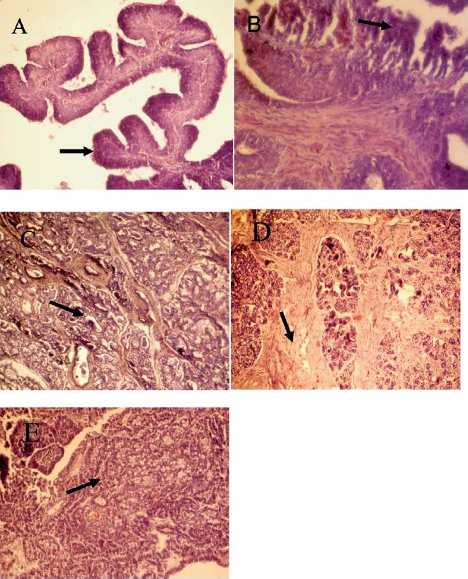 Histopathological section of mammary tumours. A, Papilloma; B, Fibroma; C, Adenoma; D, Fibroadenoma and E, Adenocarcinoma. H&E; ×400.