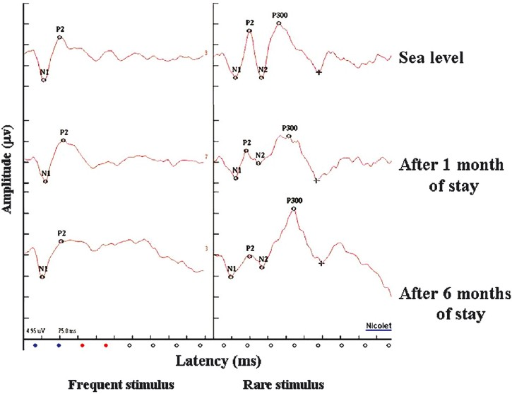 Representative waveform depicting the prolongation of P300 latency at 1 and 6 months of residence at 4115 m, whereby indicating towards furthering of deleterious effect of hypoxia with respect to time of stay at high altitude. However, amplitude of P200 and P300 peaks did not show any significant change indicating no compensatory mechanism in force. N1, negative peak 100; P2, positive peak 200; N2, negative peak 200; P300, positive peak 300.