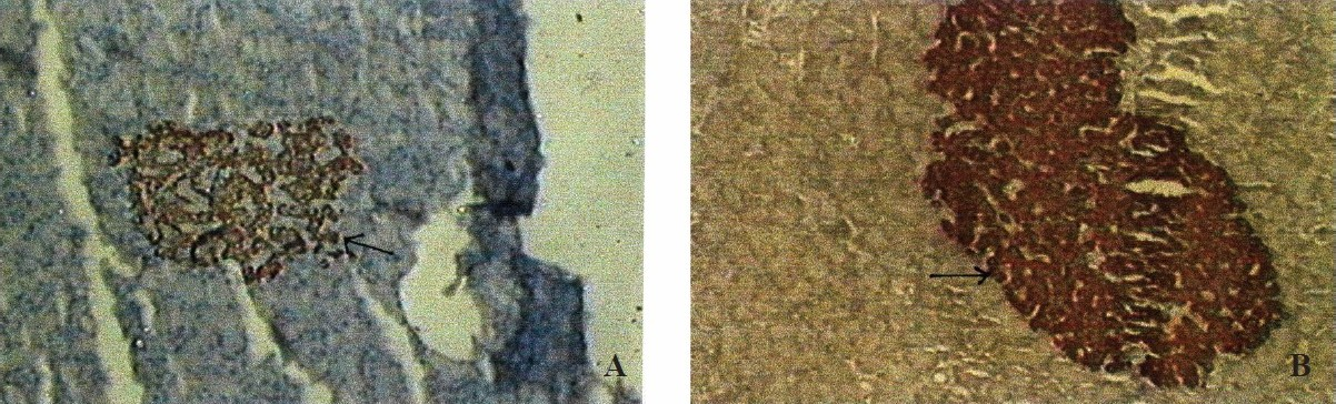 Photomicrograph of ß - cell density in islet of WNIN/GR-Ob lean (A), and obese rats (B) (Number of ß - cell represented by arrows).