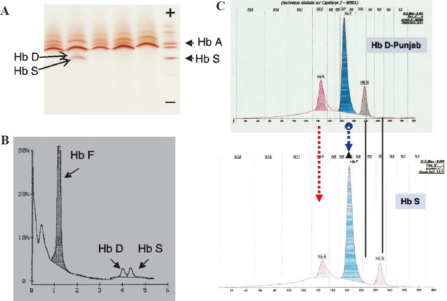Neonatal diagnosis for Hb S and Hb D-Punjab. Analysis of RBC lysates obtained from a dried blood spot obtained during the neonatal screening programme done in our laboratory. Analysis by two methods is required for the diagnosis. (A) Isoelectric focusing: Hb S and Hb D-Punjab have close isoelectric points and the resolution between the two bands is poor. The absence of HbA and thickening of HbS band help to diagnose. (B) Cation-exchange HPLC shows two abnormal peaks: one is eluted in S window and the other in the D window. (C) Capillary electrophoresis: (above): newborn heterozygous for Hb D-Punjab and (below): newborn heterozygous for Hb S. The two Hbs have different migrations.