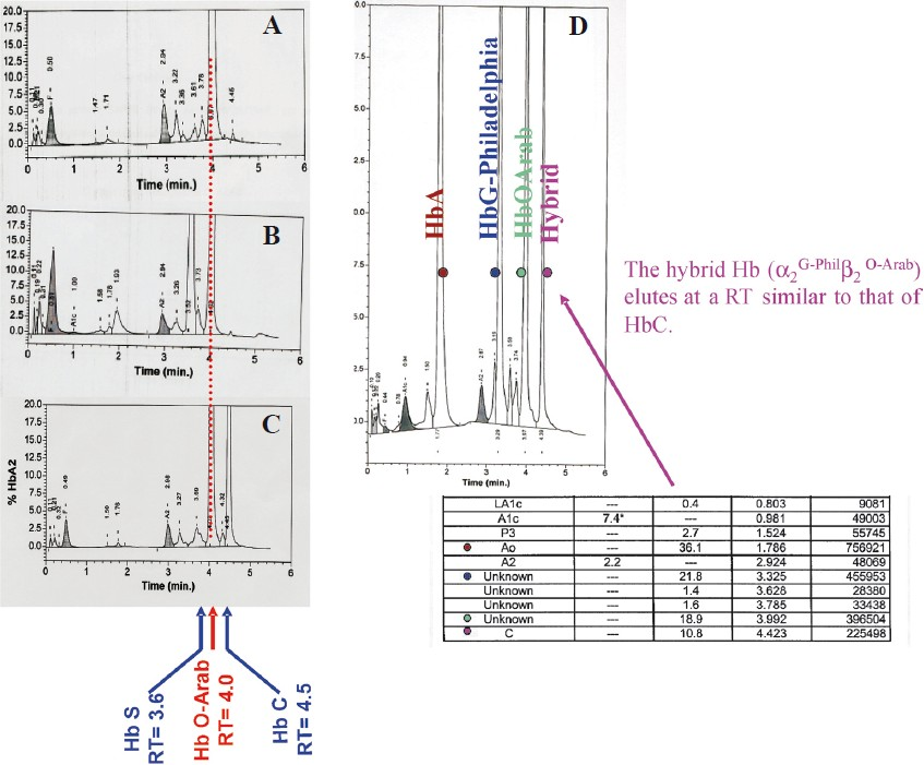 CE-HPLC: Analysis of haemolysates from patients presenting with different associations involving Hb O-Arab. (A) Compound heterozygous Hb O-Arab/β°thalassaemia. (B) Compound heterozygous Hb S/HbO-Arab. (C) Compound heterozygous Hb C/Hb O-Arab. (D) Heterozygote Hb O-Arab associated with G-Philadelphia. The hybrid Hb (α2G-Philβ2O-Arab) elutes in C window.