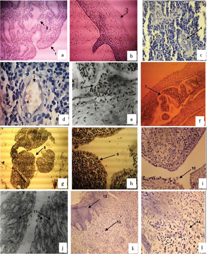 Hematoxyline & Eosine stained tissue sections of normal endometrium; [a (10X), 1: columnar epithelial cells of endometrial lining, 2: endometrial glands], normal ectocervix [b (10X) 3: stratified squamous epithelial cells of ectocervix], and patients with chronic endometritis [c & d (20X & 40X), 4 & 5: Endometrial curettings showed mainly acute inflammatory exudate consisting of polymorphs and endometrial glands infiltrated by lymphocytes], chronic non-specific cervicitis [e & f (40X & 10X), 6 & 7: focal squamous metaplasia], chronic cervicitis [g & h, (10X & 40X), 8 & 9: endocervical curettings with fragmented endocervical tissue lined by endocervical lining epithelium of columnar cells] chronic salpingitis [i, (10X), 10: tissue sections from fallopian tube showed flattened tubal lining epithelium with loss of plica and some sections showed plical adhesions], chronic salpingo-oopheritis [j (40X), 11: fallopian tubes showed inflammatory infiltrate comprising plasma cells, lymphocytes and polymorphs}, acute on chronic cervicitis] [k (10X), 12 & 13: cervix showed keratinised lymphoplastic squamous epithelial lining and stroma with mild chronic inflammation, l (40X), 14: infammed stroma].