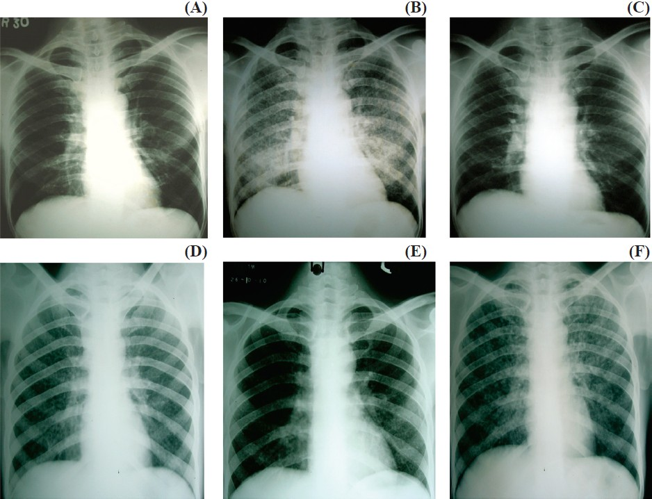 Types of IRIS: A, B and C shows unmasking IRIS; D, E, F shows paradoxical IRIS. (A) Asymptomatic patient when started on ART; (B) developed miliary TB after ART –unmasking reaction; (C) After ATT showing resolution; (D) Patient with miliary TB at baseline; (E) After 1 month of ATT treatment; (F) After ART showing flare up of lesion (paradoxical reaction).