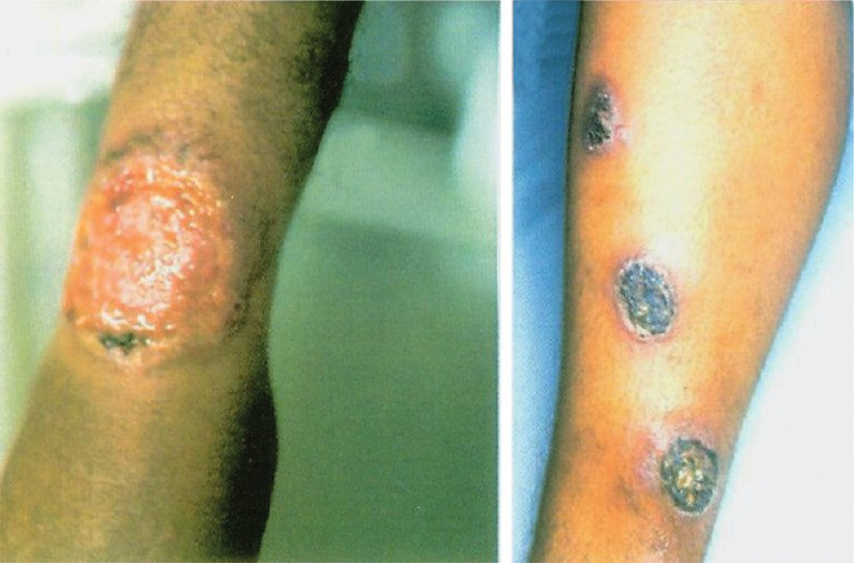Clinical features of cutaneous leishmaniasis. Chronic ulcerative lesions of the lower limb as a result of infection with Leishmania tropica.