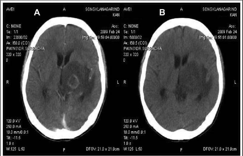 Neuroimaging findings of cerebral toxoplasmosis in an AIDS patients. (A) Contrast enhanced CAT brain showed a ringenhancing lesion and marked surrounding vasogenic brain oedema. (B) Contrast enhanced CAT brain showed a resolution of cerebral lesion after 4 wk of anti-Toxoplasma therapy.