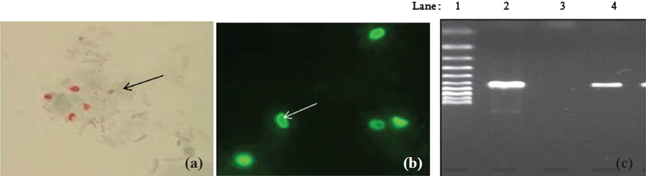 (a) Stool smear stained with modified trichome stain showing microsporidial spores (arrow); (b) Stool smear stained by Uvitex 2B & examined with UV light. spores of microsporidia show typical elongated shape (arrow); (c) Agaraose gel electrophoresis of PCR product agarose gel electrophoresis of polymerase chain reaction (PCR product. Lane1: Marker 100 bp, Lane 2: positive sample, Lane 3: negative control and Lane 4: positive control).