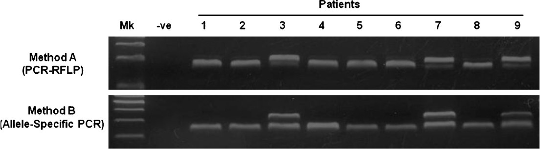 SMN1 (exon 7) deletion analysis using method (A) and (B). In method (A), deletion or non-deletion is indicated by the absence or presence of the first band (188 bp). The second band (164 bp) shows the presence of SMN2 (exon 7). In method (B), deletion or non-deletion is indicated by the absence or presence of the first band (307 bp). The second band (240 bp) indicated the presence of reference gene (β-globin). Molecular markers were electrophoresed in the “Mk” lane and a control PCR product in the “–ve” lane. Patients 1, 2, 4, 5, 6, 8 show deletion of SMN1. Patients 3, 7, 9 show non-deletion of SMN1.