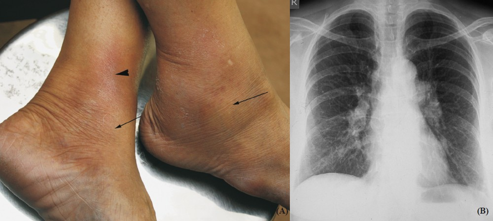 Lofgren syndrome. (A) Middle-aged lady presented with bilateral ankle arthritis (arrows) and erythema nodosum (arrow head). (B) Chest radiograph of the same patient showing bilateral hilar adenopathy. Acute sarcoidosis in the form of Lofgren's syndrome is rare in India.