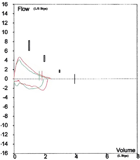 Flow volume loops showing reversible airways obstruction in patient with sarcoidosis.