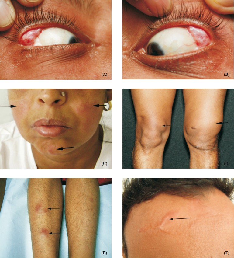 Clinical images in sarcoidosis. Bilateral lacrimal gland enlargement seen in a patient with sarcoidosis, right eye (A) and left eye (B). (C) Multiple erythematous plaques with superficial epidermal atrophy on exposed areas and sparing of nasolabial folds. The differentials include rosacea and lupus erythematosus. (D) Swollen left knee joint (thick arrow), synovial thickening of right knee joint (thin arrow). Synovial biopsy revealed non-caseating granulomas compatible with sarcoidosis. (E) Erythematous, tender nodules over extensor aspect of both legs suggestive of erythema nodosum, a non-specific cutaneous lesion in sarcoidosis, (F) Erythematous barely elevated plaque with well-defined margins developed on a scar over forehead (arrow). Skin biopsy revealed non-caseating granulomas. This condition is known as scar sarcoidosis and may be mistaken for keloids.