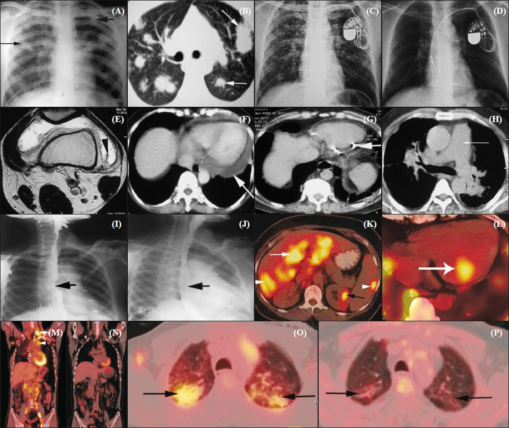 Imaging in sarcoidosis. (A) Chest radiograph showing multiple poorly defined nodular shadows (arrows) in bilateral lung fields (B) HRCT scan axial section of the same patient showing large, discrete nodules (arrows) with fluffy margins in both lungs compatible with alveolar form of sarcoidosis. (C) Chest radiograph showing bilateral upper zone reticulonodular shadows; permanent pacemaker is also noted. Supraclavicular lymph node biopsy showed noncaseating epithelioid granulomas. The patient was referred with a possible diagnosis of MDR-TB. (D) Chest radiograph of the same patient after 6 months of corticosteroid therapy showing good response to treatment. (E) Axial T2W MR image of knee joint showing effusion in the joint space with synovial hypertrophy (arrow head). Synovial biopsy revealed non-caseating granulomas. (F) Axial CECT section showing pericardial effusion (arrow). There was good response to corticosteroids. (G) Axial CT scan of the chest showing pericardial calcification (arrow). (H) Axial CECT section showing significantly dilated main pulmonary artery (arrow). The diameter is more than adjacent aorta suggesting pulmonary hypertension. There is also marked peribronchovascular interstitial thickening. (I) Barium swallow image showing a localized filling defect (arrow) in mid-thoracic esophagus in a patient complaining of dysphagia for 3 months. CT revealed a subcarinal lymph nodal mass compressing the thoracic esophagus. (J) There was significant improvement in symptoms and radiographic appearance (arrow) after 3 months of corticosteroid treatment. (K) FDG PET-CT axial section showing increased focal uptake in liver (white arrow), spleen (arrow head) and kidney (black arrow). (L) FDG PET-CT axial section shows increased focal uptake in myocardium in a patient with cardiac sarcoidosis. (M) Coronal section FDG PET-CT scan showing increased FDG uptake in supraclavicular (arrow), mediastinal (arrow head), axillary and multiple mediastinal nodes in a patient with sarcoidosis. (N) Follow-up image after 6 months in the same patient shows good response with no abnormal uptake noted. (O) FDG PET-CT axial section showing increased uptake in parenchymal lesions (arrows) at initiation of therapy. (P) The parenchymal lesion showing no FDG uptake (arrows) in the same patient after 6 months of corticosteroid therapy.