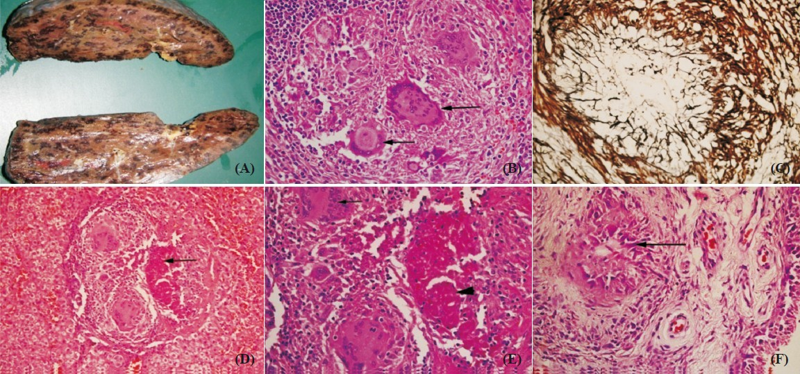 Histopathological images. (A) Cut surface of spleen showing nodular lesions. (B) Microscopic examination from the lesions showing necrotizing granulomatous reaction with Langhans giant cells (arrows) on H&E stain; 400×. (C) These granulomas are rich in reticulin fibers as seen on silver stain; 200×. (D & E) Liver biopsy showing granulomatous reaction in the portal tract with Langhans giant cells and areas of necrosis (arrow in D and arrow head in E) on H&E stain at 100 & 200x respectively. (F) Arthroscopic synovial biopsy showing non-caseating granulomas (arrow) on H&E stain; 100×.