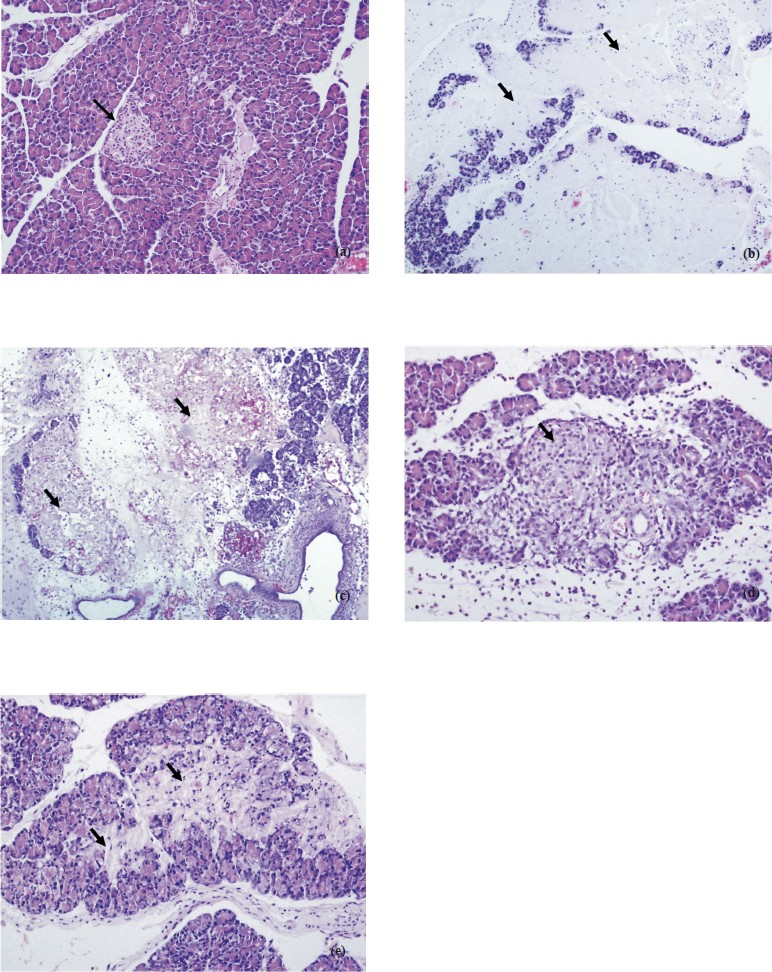 (a): Normal pancreas panceatic islet close to center area and normal acinar around (arrow). H&E × 200. (b). Group I extensive parancyhmal necrosis of acinar (arrows). H&E × 100. (c). Group II extensive parancyhmal necrosis o Acinar. H&E × 100. (d). Group III recovery-slightly fibrosis-parancyhma islet in the center and replacement of aciner structures with fibrosis in the inferior area (arrow). H&E × 200. (e). Group III Parancyhmal injury-recovery with slightly fibrosis replacement of acinar structures with fibrosis in the inferior area (arrows). H&E × 200.