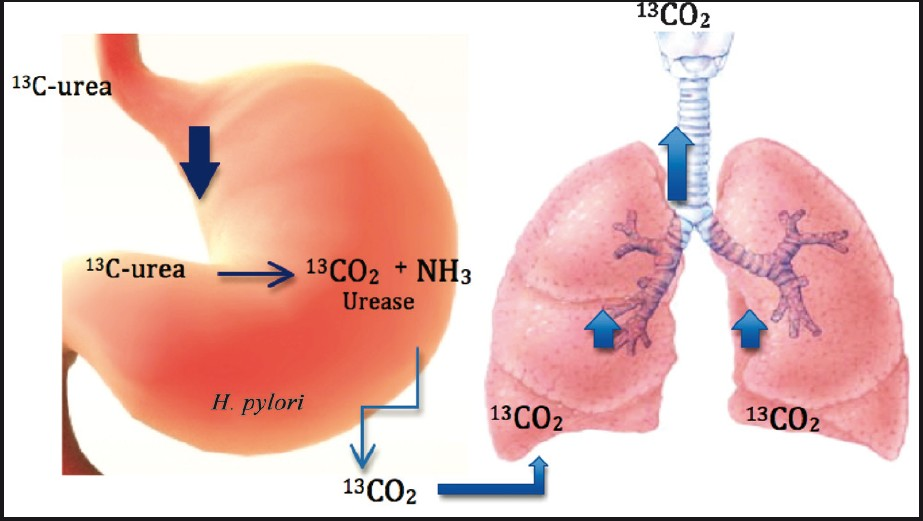 Labelled urea is degraded by H. pylori in the stomach whereby the labelled CO2 produced is then exhaled and detected in the lungs. The detection of the labelled CO2 implies infection with H. pylori.