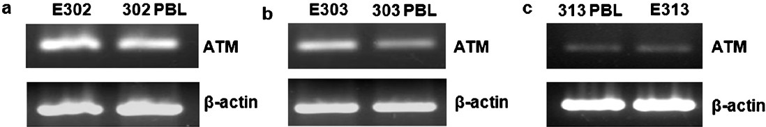 Expression of ATM gene in different cell lines and their respective PBLs (a) E302 (b) E303 (c) E313. RT-PCR products were run in 2 per cent agarose gel stained with ethidium bromide. β-actin gene was taken as loading control.