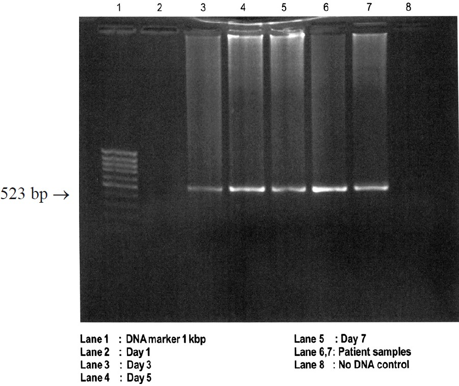 Detection of viral RNA by RT-PCR on different days post-inoculation of fixed rabies virus and patients’ samples in newborn mice brain.