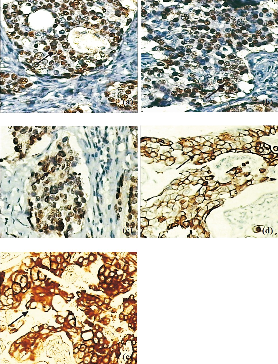 (a) Nuclear expression of estrogen receptor (ER) in breast cancer (arrow) (200×). (b) Progesterone receptor (PR) nuclear positivity in infiltrating ductal carcinoma breast (arrow) (200×). (c) Androgen receptor (AR) expression in nuclei of tumour cells (arrow) (200×). (d) Membranous expression of epidermal growth factor receptor (EGFR) in tumour cells (arrow) (200×). (e) Membranous and cytoplasmic expression of endoglin (CD105) in breast cancer (arrow) (200×).