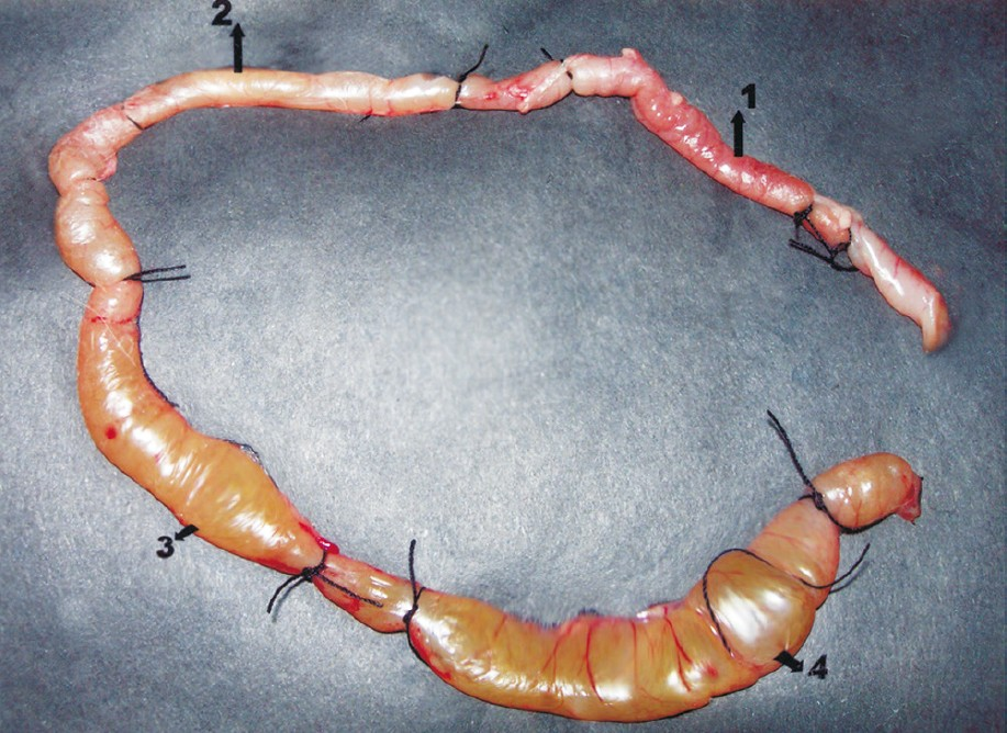 Inhibitory effect of lacidipine on cholera toxin-induced fluid accumulation in the rabbit ileal loop. There was no swelling in loop 1 (receiving only peptone water) and very little swelling in loop 2 (receiving challenge plus 200 μg lacidipine). Ballooning effect was observed in loop 3 which had challeng plus 100 μg of lacidipine. Ballooning effect was more pronounced in loop 4 which was given only the challenge.