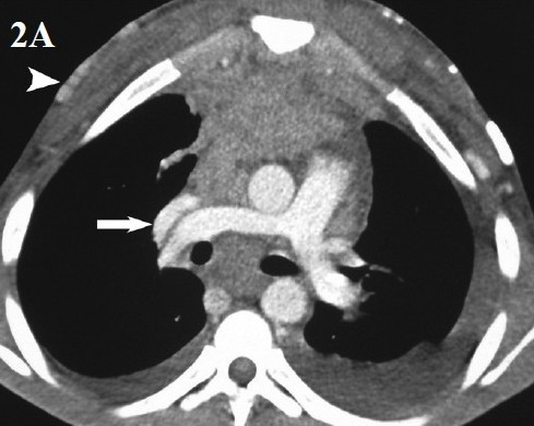 CECT scan of the chest shows soft tissue density in the anterior and middle mediastinum encasing the SVC, aorta and pulmonary artery. SVC is chinked (arrow) with formation of multiple collaterals in the chest wall (arrowhead).
