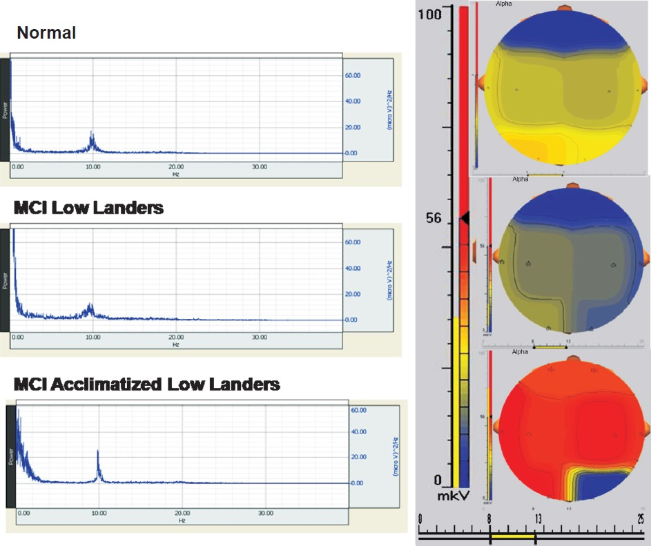 Power spectrum analysis of alpha waves. Comparison of spectral brain maps for regional activity of Normal, MCI individuals.