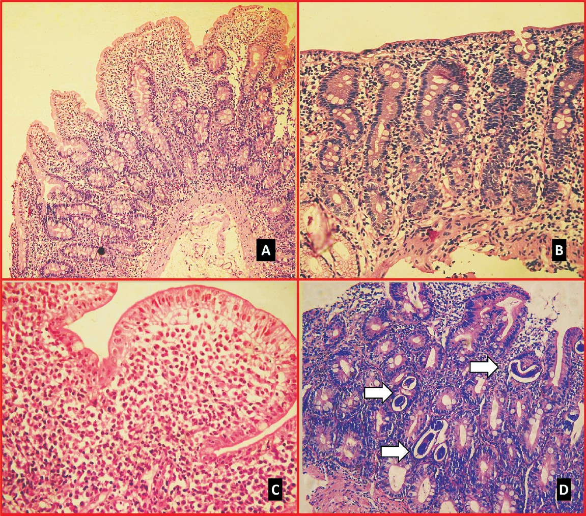 Histological examination of duodenal biopsies in patients with malabsorption syndrome. (A) Patient with tropical malabsorption showing blunting of villi with increased mononuclear infiltrate in lamina propria, (B) subtotal villous atrophy with crypt hyperplasia in a patient with celiac disease, (C) dense dysplastic lymphomononucler infiltrate with blunting of villi in a patient with immunoproliferative small intestinal disease, (D) larvae of Strongyloides embedded in the mucosa (haematoxylin-eosin).