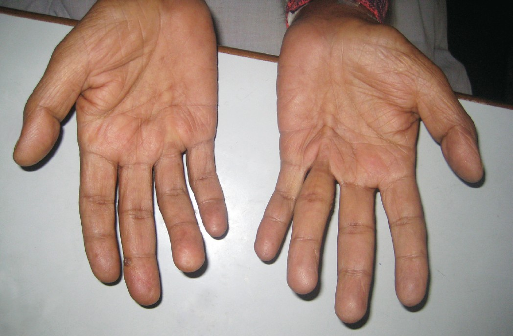 Dupuytren's contracture involving both hands.