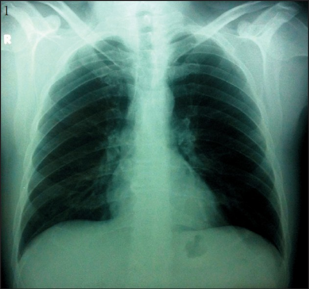 Chest X-ray of the patient shows normal findings.