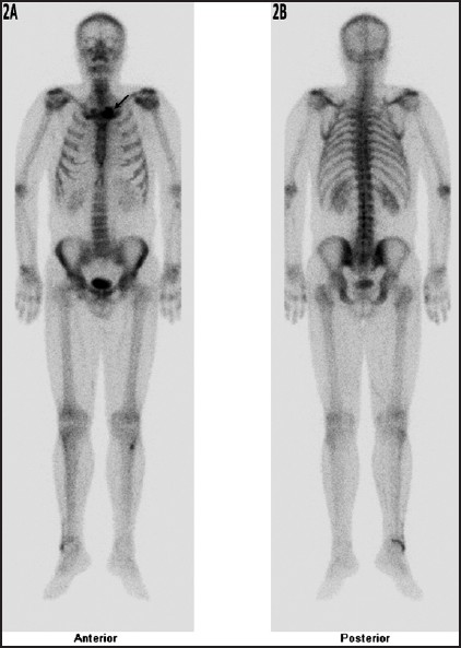 Anterior and posterior whole body scintigraphic image showing left SCJ involvement (arrow).