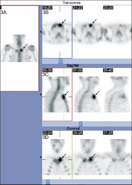 Bone scintigraphic image showing left SCJ involvement (arrows) due to brucellosis.