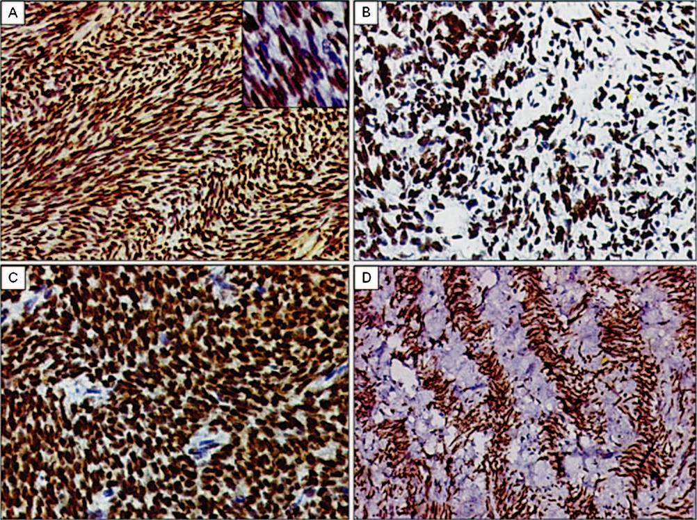 TLE1 expression in spectrum of monophasic spindle cell type synovial sarcomas. A. Diffuse TLE1 positivity (3+) highlighting herring-bone like pattern in a monophasic type of synovial sarcoma. DAB × 200. Inset. Higher magnification showing intense nuclear positivity. DAB × 400. B. TLE1 positivity in a tumour with focal myxoid differentiation. DAB × 200. C. TLE1 positivity (3+) in a synovial sarcoma exhibiting hemangiopericytomatous pattern. DAB × 400. D. TLE1 positivity (3+) in a case of monophasic synovial sarcoma exhibiting prominent palisading/scarring pattern. DAB × 200.
