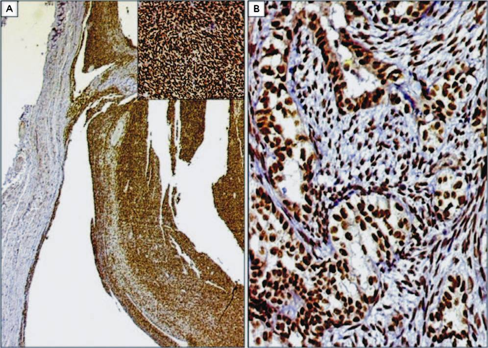 A. Cystic change in a case of monophasic synovial sarcoma exhibiting diffuse TLE1 expression. DAB × 40. Inset: Higher magnification showing intense TLE1 positivity within tumour cells arranged in hemangiopericytomatous pattern. DAB × 200. B. Intense TLE1 positivity in a case of biphasic synovial sarcoma. The glandular and spindly components display similar intensity of TLE1 expression. DAB × 200.