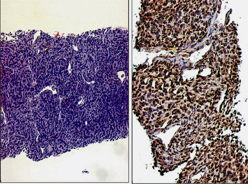 Case of a monophasic synovial sarcoma diagnosed on a small core biopsy. A. Tumour showing hemangiopericytomatous pattern. B. Diffuse, intense TLE1 positivity (3+). DAB × 200.