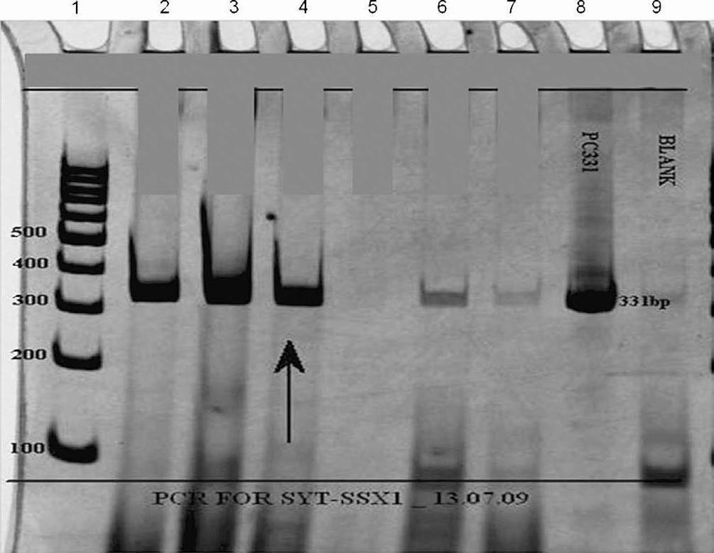 Polymerase chain reaction (PCR) analysis of SYT-SSX translocation using SYT and SSX1 primers. Reactions were subjected to electrophoresis on 10% polyacrylamide gel. Lane 1: the DNA size markers in base pairs (bp); Lanes 2 and 3: PCR run performed with cDNA from an already reported positive cases (331 bp) acting as positive control; Lane 4: PCR run performed with cDNA from test sample (arrow) showing positive band (331 bp); Lane 5: PCR run performed with cDNA from an already reported negative case acting as negative control; Lane 6: PCR run performed with cDNA from an earlier case, revealing weak band, interpreted as “inconclusive”; Lane 7: PCR run performed with cDNA from an unrelated tumour acting as negative control; Lane 8: Positive control DNA (pTZ57R/T-SYT-SSX1-331bp); Lane 9: PCR amplification without DNA template (Blank) to rule out contamination.