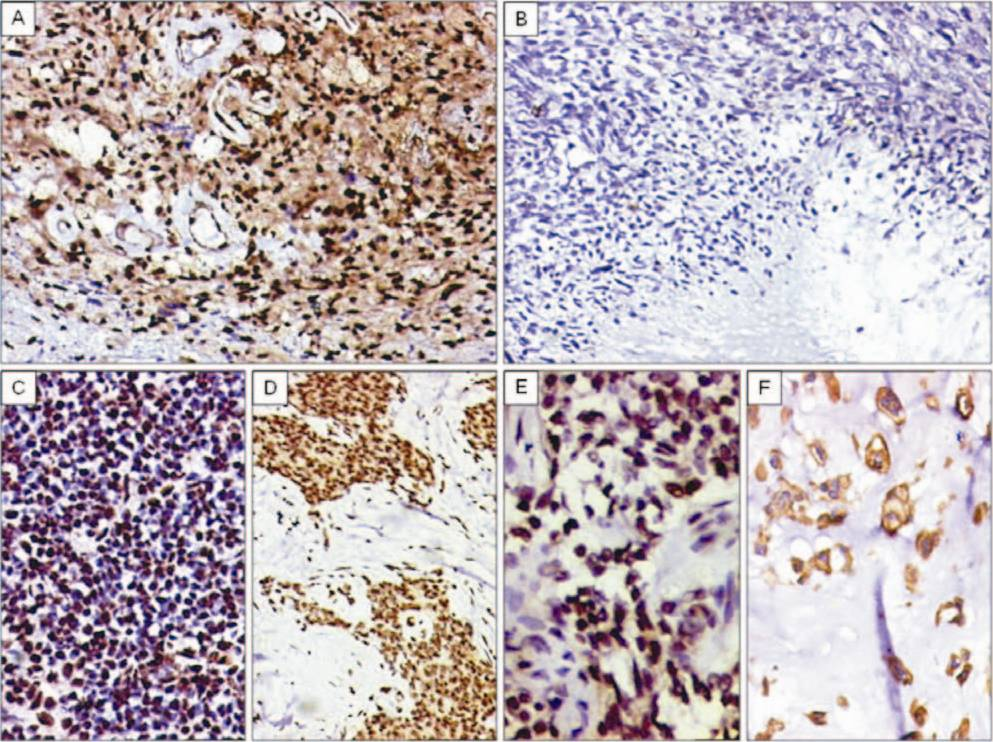 A. Diffuse TLE1 positivity in a neurilemoma/schwannoma. TLE1 positivity also noted within endothelial cells of vessels. DAB × 200. B. TLE1 negativity in MPNST (high-grade) DABx 200C. C. TLE1 positivity (2+) in a case of Ewing sarcoma/PNET. DAB × 200. D. TLE1 positivity (3+) in a desmoplastic small round cell tumour (DSRCT). DAB × 200. E. TLE1 positivity (2+) noted in a case of adamantinoma. DAB × 400. F. Negative nuclear staining, but positive cytoplasmic staining for TLE1 in chordoma. DAB × 400.