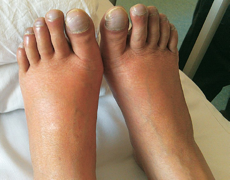 Clubbing and cyanosis of bilateral toes.