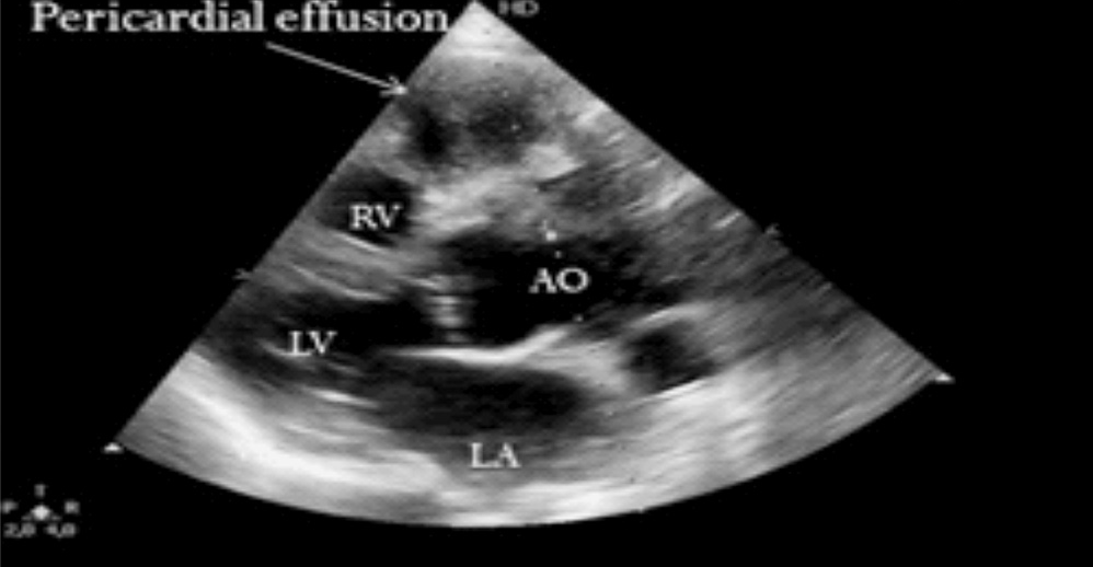 2 D Echocardiogram showing a small pericardial effusion.