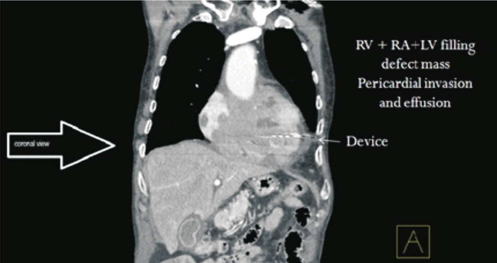 Tricuspid Doppler flow with gradient.