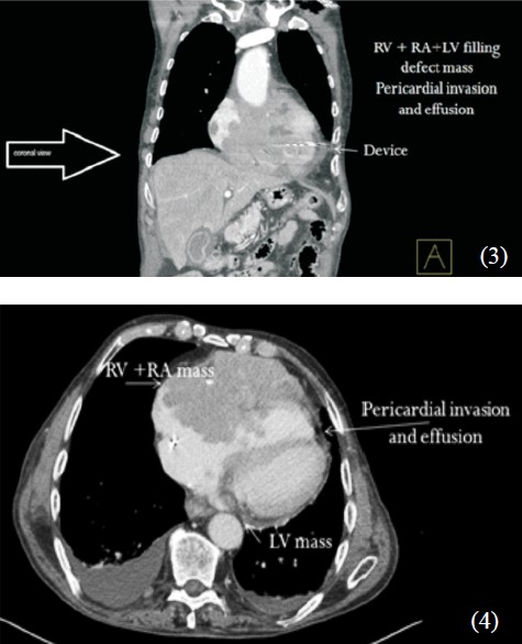 CT angiogram with mass lesion (RV, LV, right & left ventricle; RA, LA, right & left atrium).