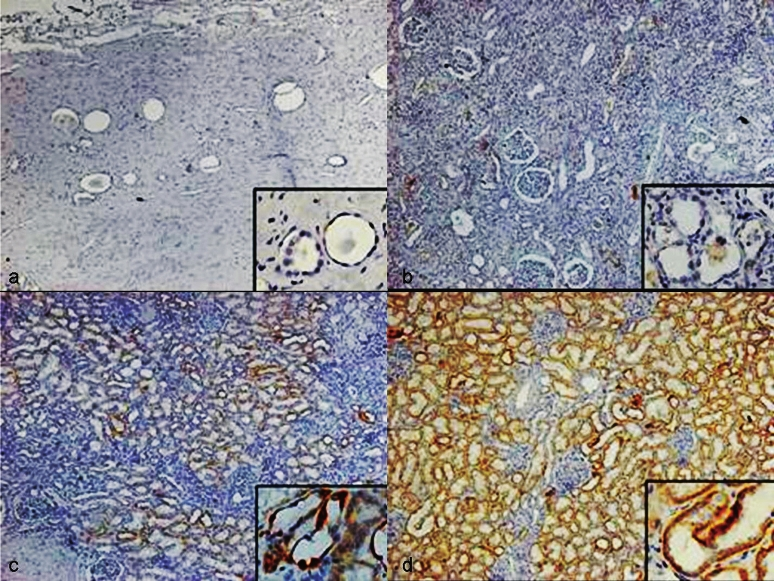 HIF-1α expression in the epithelium of cortical tubules. (a). Interstitial fibrosis score 3, glomerulus fibrosis score 3, eGFR 7.1 ml/min: HIF-1α expression 0. (b). Interstitial fibrosis score 3, glomerulus fibrosis score 1, eGFR 38.2 ml/min: HIF-1α expression 1. (c). Interstitial fibrosis score 1, glomerulus fibrosis score 0, eGFR 50.1 ml/min: HIF-1α expression 2. (d). Interstitial fibrosis score 0, glomerulus fibrosis score 0, eGFR 101.4 ml/min: HIF-1α expression 3. The magnification for Fig. is 40× and the insets in Fig. a, b, c and d mean higher magnification of corctical tubules with HIF-1α expression (400×).