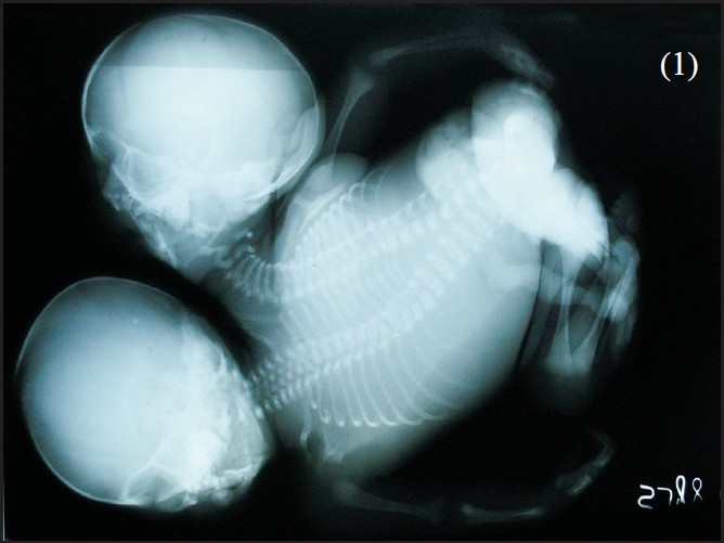Babygram of dicephalic conjoined twin.