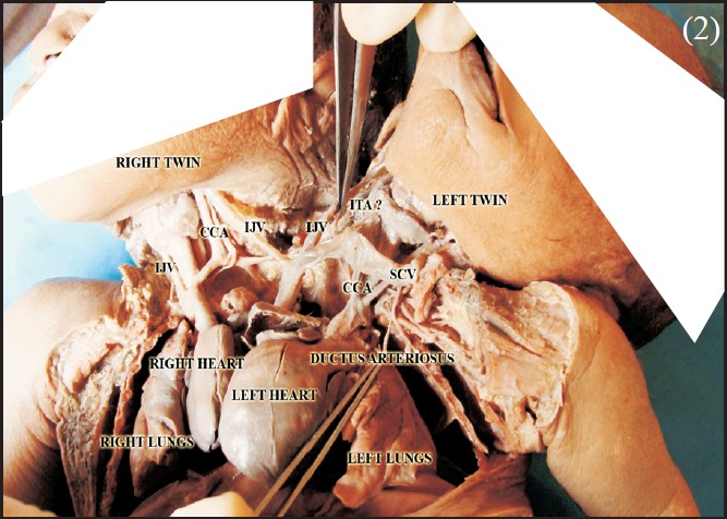 Anterosuperior view of dicephalus twin showing conjoined heart and its great vessels.