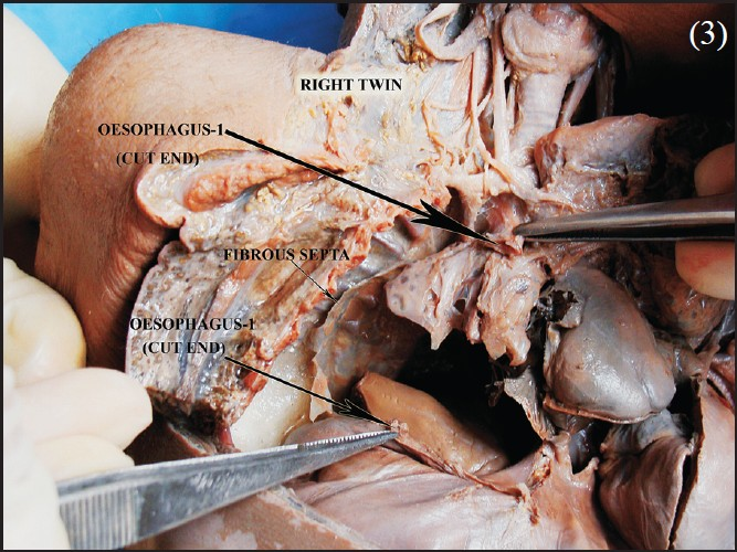 Dissected part showing thoracic anomalies.