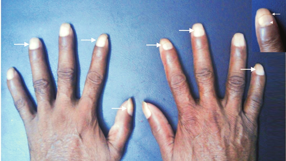 Clinical photograph showing transverse grooves (Beau's lines) on nail plates of all digits (arrows) at similar distances from nail fold. Inset: Close-up view of Beau's line (arrow) on right index finger parallel to lunula (arrow head).