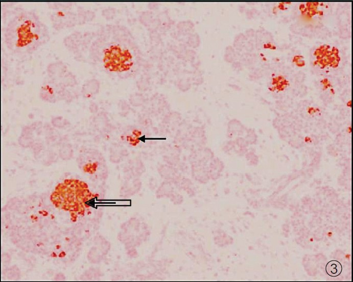 Low BMI subject - Photomicrograph of pancreas showing fully formed islets (Thick arrow) and micro islets with insulin (dark brown stain - Thin arrow). IHC × 100.