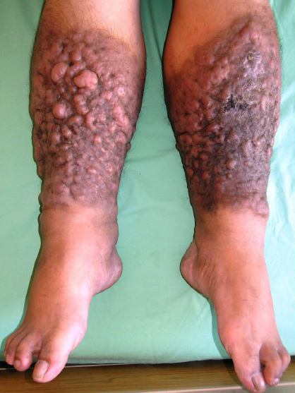 Multiple waxy, indurated, nonpitting plaques and nodules with peau d’orange appearance and hyperpigmentation developing on bilateral legs.